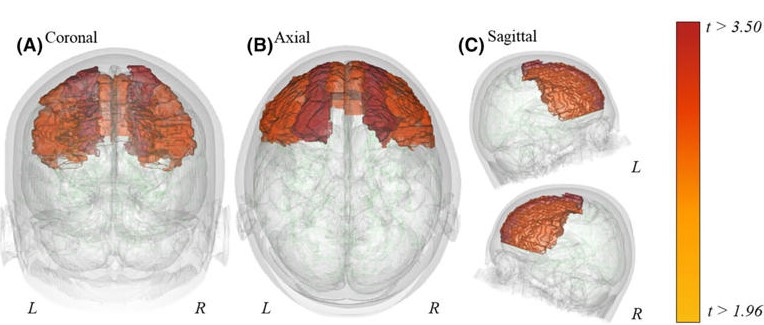 Far from 'fussy eaters' - first neuroimaging study demonstrates significant changes in the brains of children with ARFID